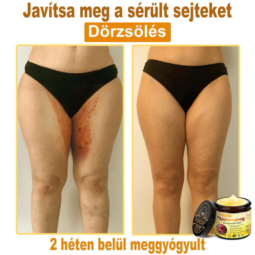 🐝PUROSA® Méhméreg Bőrmegújító Krém｜Teljes körű megoldás a makacs bőrproblémák, például az öregedés, ekcéma, hegek és pikkelysömör ellen