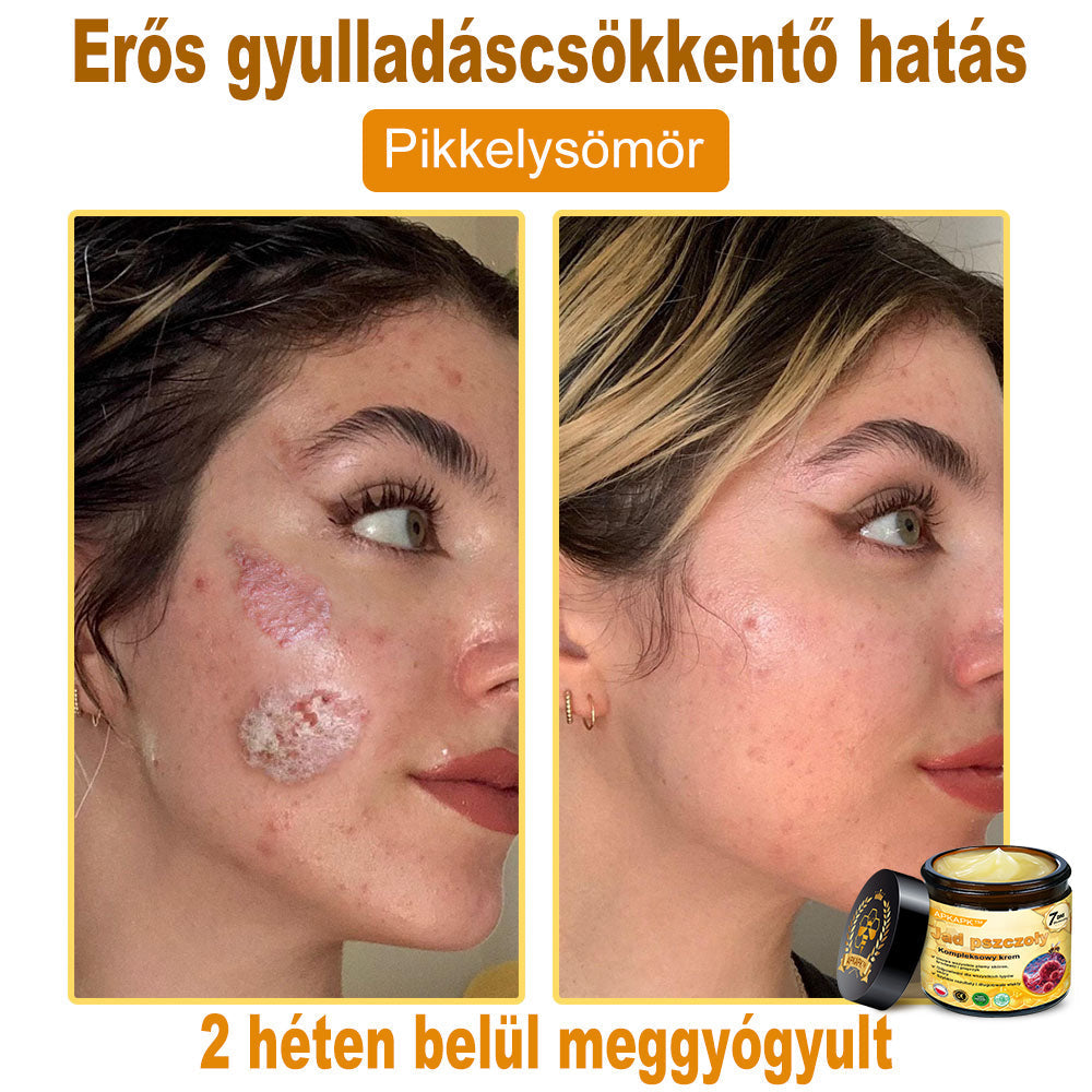 Utolsó nap! Már csak 5 tégely maradt a PUROSA® szuper kedvezményes ajánlatából! Most extra 50% kedvezménnyel teheted meg az első lépést a feszesebb és fiatalosabb bőr felé.