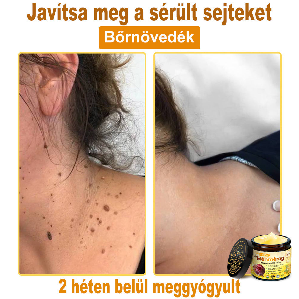 Utolsó nap! Már csak 5 tégely maradt a PUROSA® szuper kedvezményes ajánlatából! Most extra 50% kedvezménnyel teheted meg az első lépést a feszesebb és fiatalosabb bőr felé.