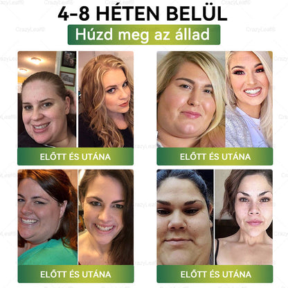 🏆Hivatalos áruház | CrazyLeaf® SMGT-GLP-1 nano tapasz kollagénnel & Matrixyl 3000-rel – Célzott hatás: elhízás,cukorbetegség,bőrmegereszkedés,  zsírmáj,  magas vérnyomás, energiaszint-csökkenés