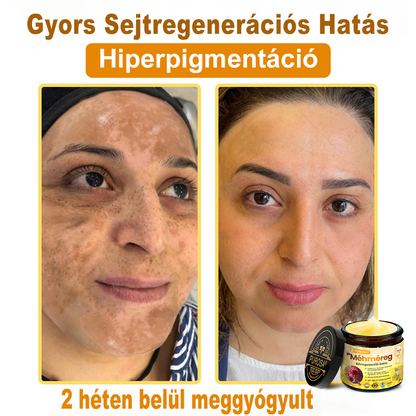 🐝PUROSA® Méhméreg Bőrmegújító Krém｜Teljes körű megoldás a makacs bőrproblémák, például az öregedés, ekcéma, hegek és pikkelysömör ellen